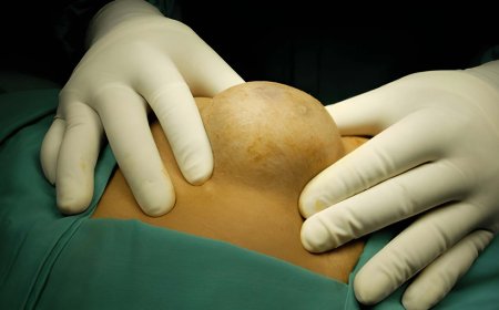 Could Early Lipoma Removal Prevent Future Skin Discomfort?