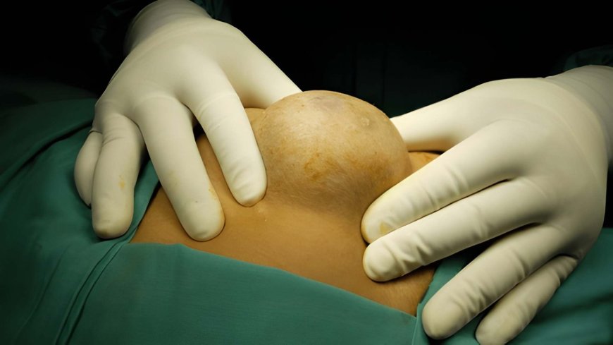 Could Early Lipoma Removal Prevent Future Skin Discomfort?