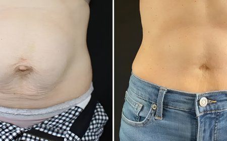 Tummy Tuck Surgery in Islamabad: What to Expect Before and After