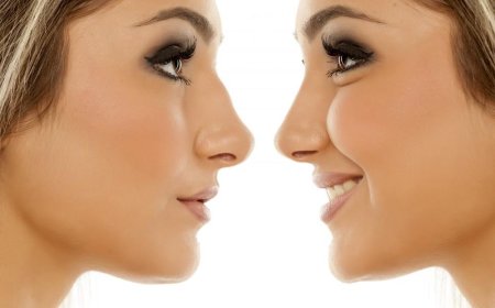 Nose Surgery in Dubai: Types, Benefits, and Healing Time