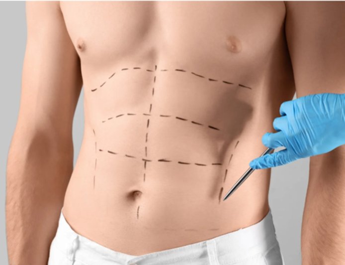 Abdominoplasty Surgery in Islamabad for Complete Body Rejuvenation