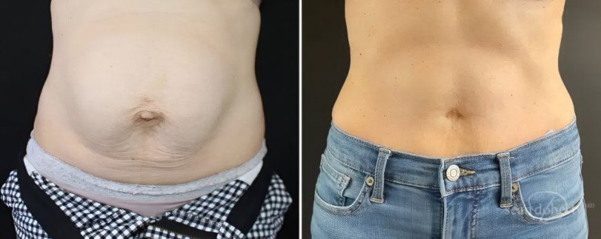Tummy Tuck Surgery in Islamabad: What to Expect Before and After