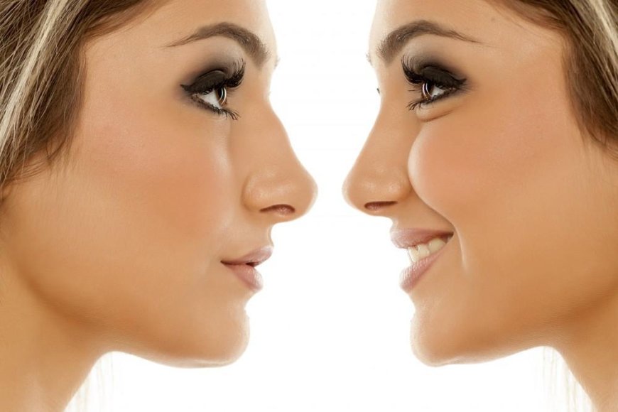 Nose Surgery in Dubai: Types, Benefits, and Healing Time