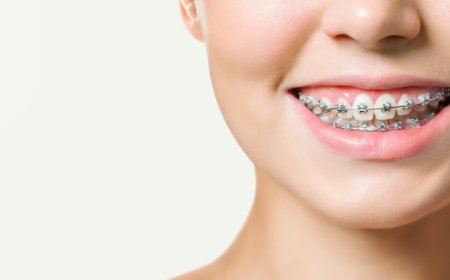 Braces Camarillo: A Complete Guide to Straighter, Healthier Smiles
