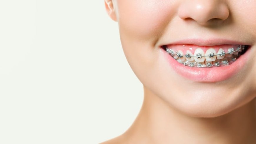 Braces Camarillo: A Complete Guide to Straighter, Healthier Smiles