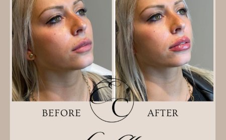 Worried Lip Filler Will Make Your Lips Look Too Big? Could a Lip Flip Be a More Subtle Alternative?