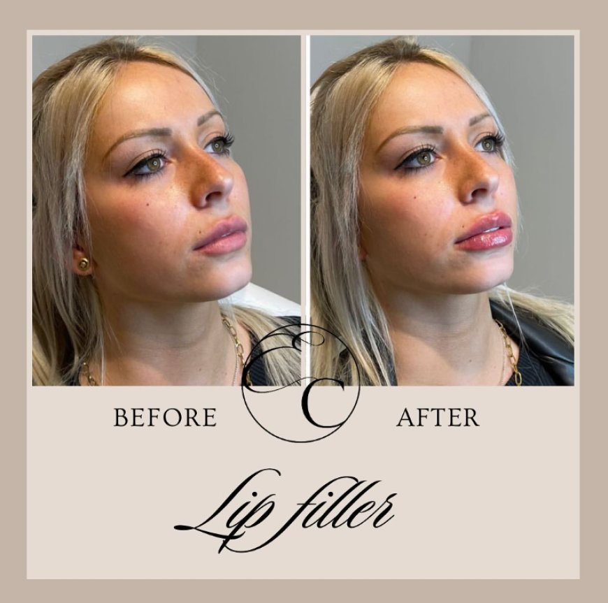 Worried Lip Filler Will Make Your Lips Look Too Big? Could a Lip Flip Be a More Subtle Alternative?
