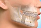 Maxillofacial Surgery vs Oral Surgery: What Is the Difference?