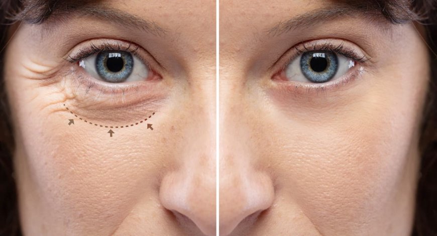 Can Eyelid Surgery Enhance Your Natural Eye Shape?