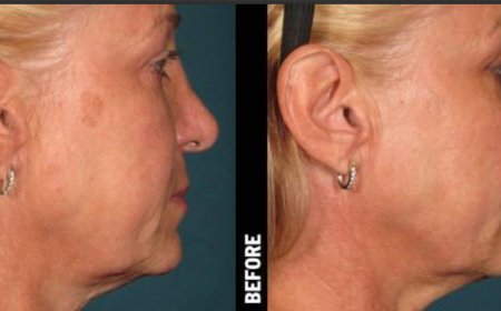 Can PRP Improve Acne Scars? What Women With Uneven Skin Should Know in 2026