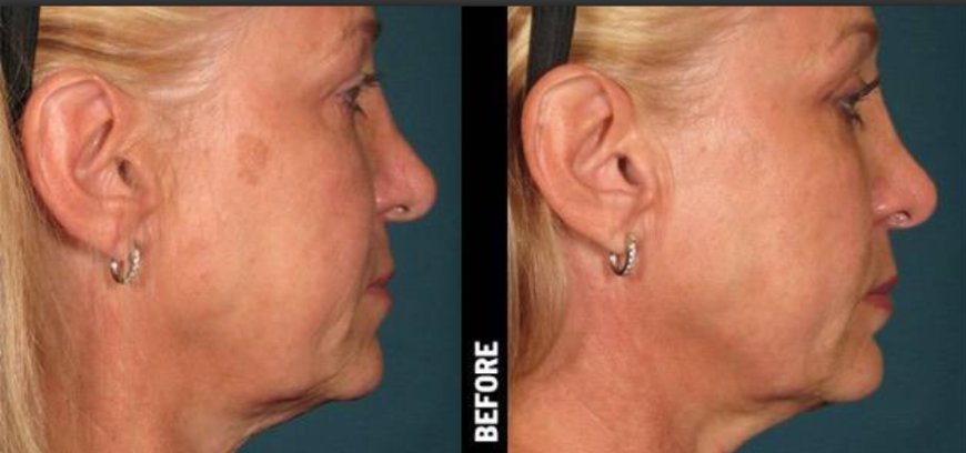 Can PRP Improve Acne Scars? What Women With Uneven Skin Should Know in 2026