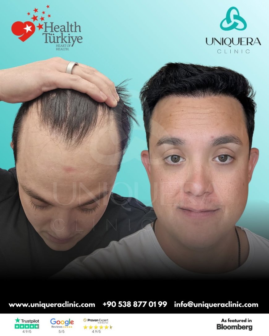 Top 10 Signs You May Need to Visit a Hair Loss Treatment Clinic in Turkey